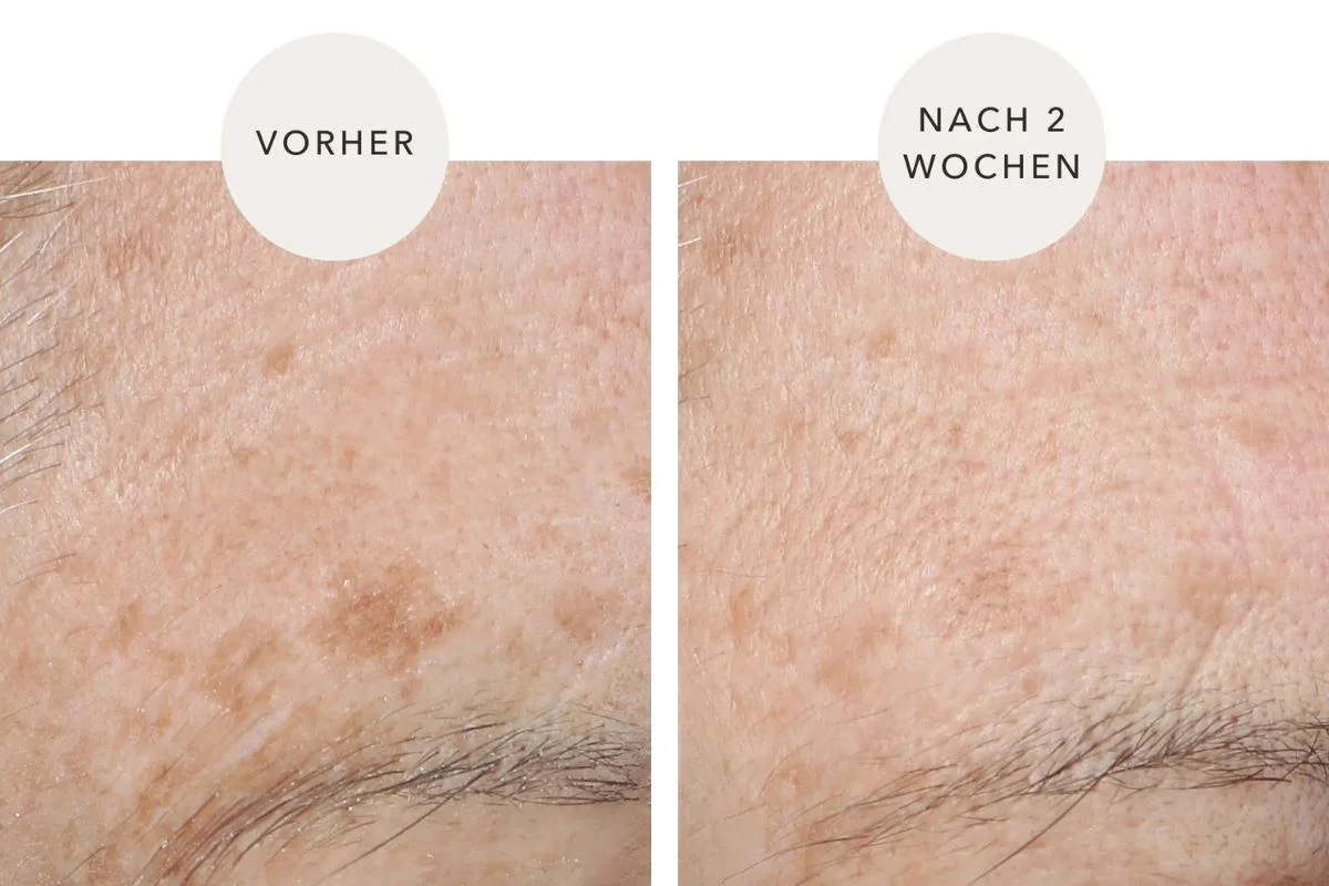 Pigmentflecken vorher und nach 2 Wochen im Vergleich