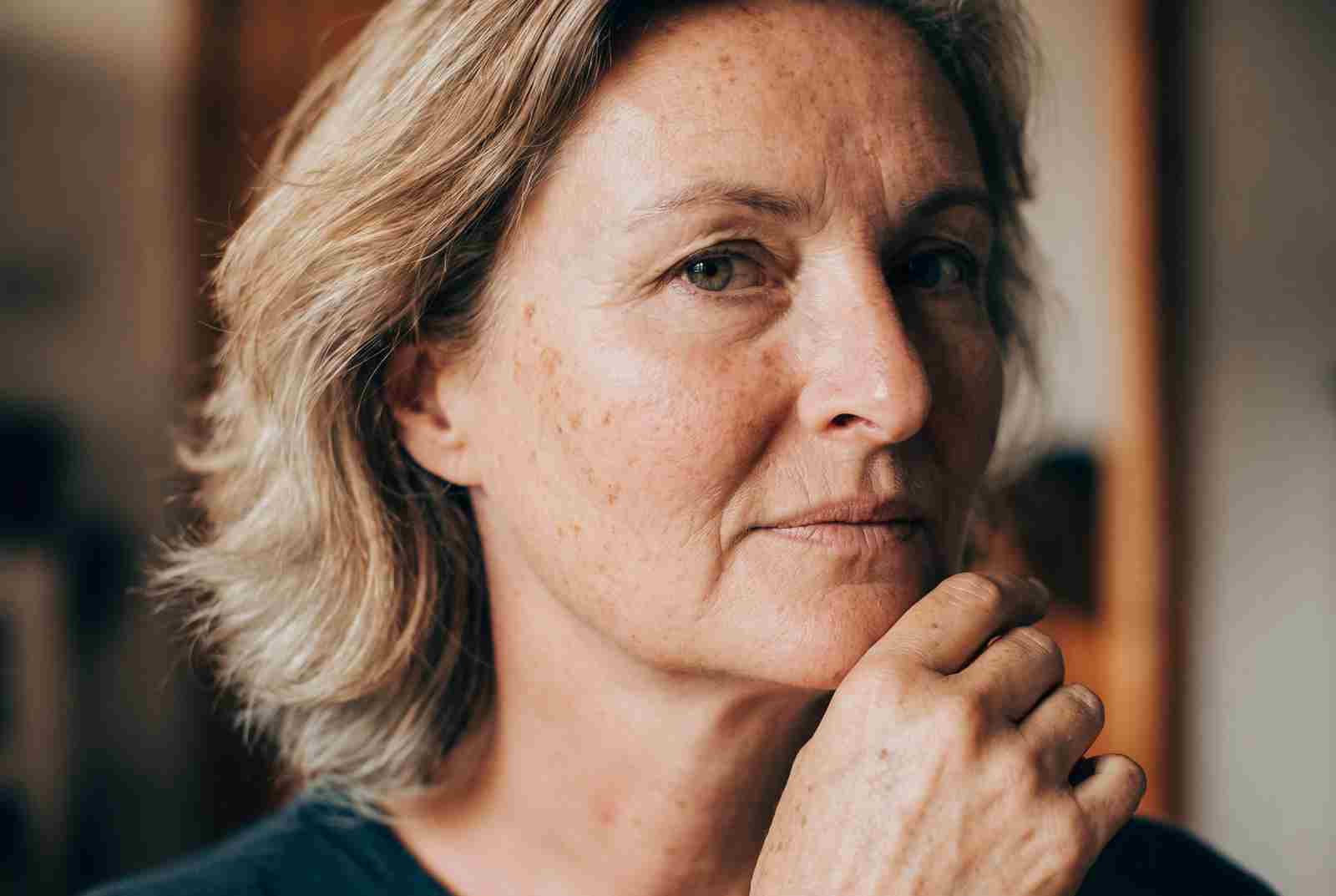 Nahaufnahme von Marions Wange mit deutlich sichtbaren Pigmentflecken, nachdenklicher Blick